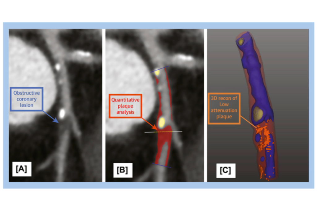 Plaque Burden and 1Year in Acute Chest Pain Translational