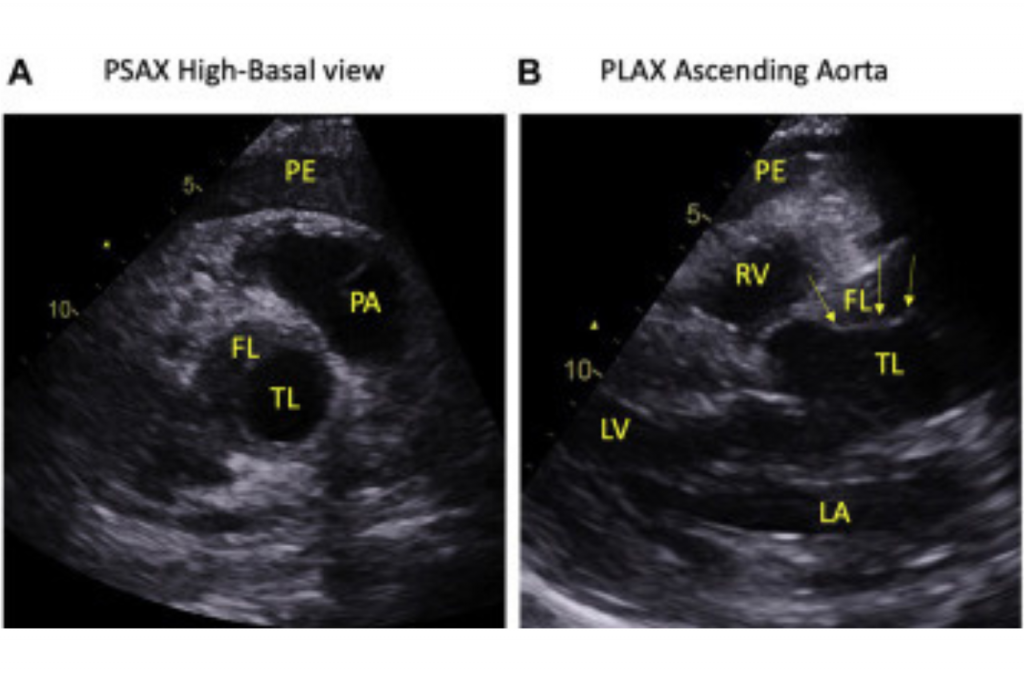 The Role of Point-of-Care Ultrasound in the Emergency Department ...